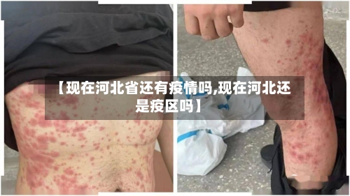 【现在河北省还有疫情吗,现在河北还是疫区吗】-第1张图片